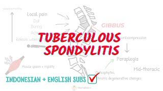 Tuberculous Spondylitis Overview and Treatment [upl. by Hew]