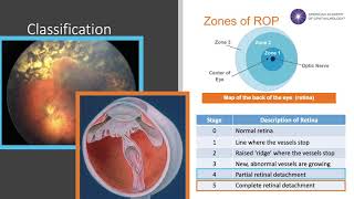 Retinopathy of Prematurity [upl. by Abraham299]