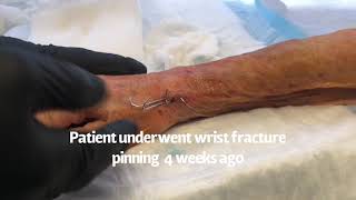 MoraMD Pin Removal Following Wrist Surgery Dr Steve Mora [upl. by Ihab]