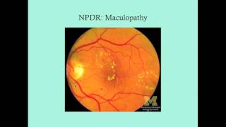 Diabetic Retinopathy  CRASH Medical Review Series [upl. by Eiraminot]