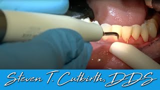 Scaling amp Root Planing  Dental Minute with Steven T Cutbirth DDS [upl. by Auhsuj]