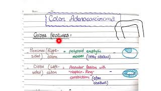 Colon Adenocarcinoma  Morphology [upl. by Rockwood]