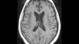 Herpes Encephalitis [upl. by Marya]