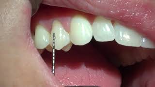 How to Measure Gingival Recession [upl. by Lean164]