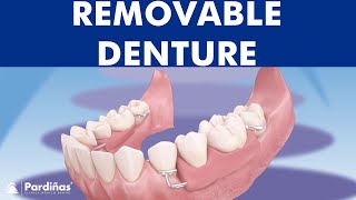 Removable partial denture © [upl. by Eibrad219]