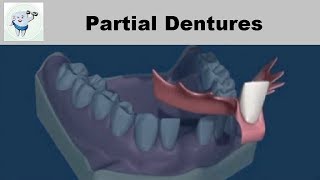 Removable Partial Dentures [upl. by Dlonyar]