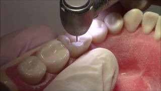 Tutorial on Class I Cavity Preparation Amalgam Restoration  DENTALKART [upl. by Dore160]