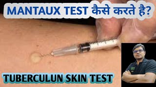 Mantoux test  TST  PPD  Tuberculin skin test  Diagnosis of TB [upl. by Hinch]