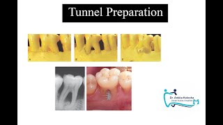 TUNNEL PREPARATIONTREATMENT OF FURCATION INVOLVEMENTDR ANKITA KOTECHADENTAL STUDIES SIMPLIFIED [upl. by Pulchia282]