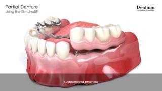 Partial denture  SlimLineSE [upl. by Fiske]