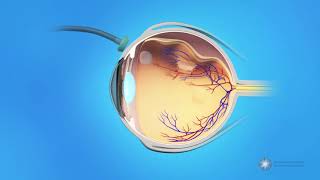 Vitrectomy Surgery for Detached Retina [upl. by Essyle]