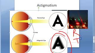 Ophthalmology 044 a Refractive Errors Of Refraction Emmetropia Ametropia Myopia HyperMetropia Eye [upl. by Anoit]